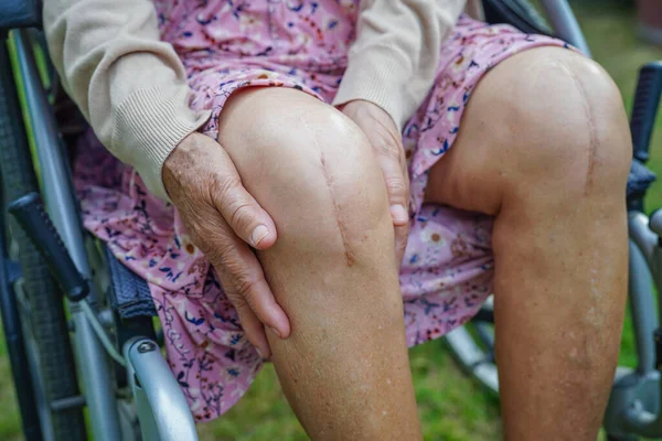 亚洲老年妇女在医院接受疤痕膝关节置换手术 — 图库照片