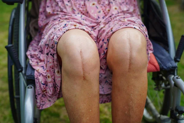 Asiática Anciana Paciente Con Cicatriz Cirugía Reemplazo Rodilla Hospital —  Fotos de Stock