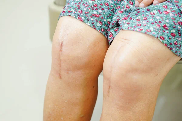 Asian elderly woman patient with scar knee replacement surgery in hospital.