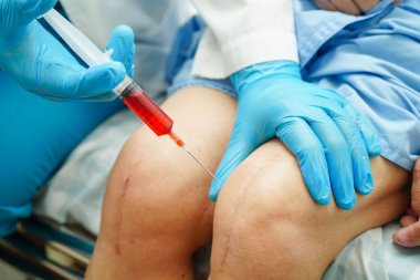 Asyalı doktor, Hyaluronic asit trombosit enjekte ederek yaşlı kadının dizine zengin plazma enjekte etti..