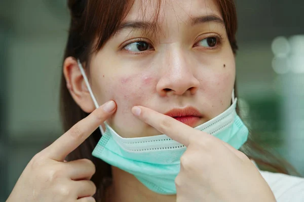 Acne pimple and scar on skin face, disorders of sebaceous glands, teenage girl skincare beauty problem.