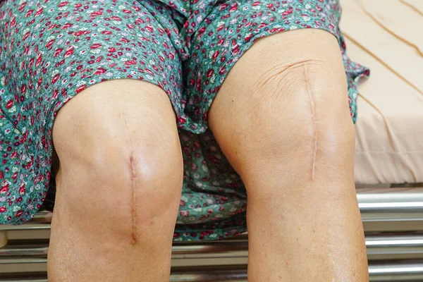 Asiática Anciana Paciente Con Cicatriz Cirugía Reemplazo Rodilla Hospital — Foto de Stock