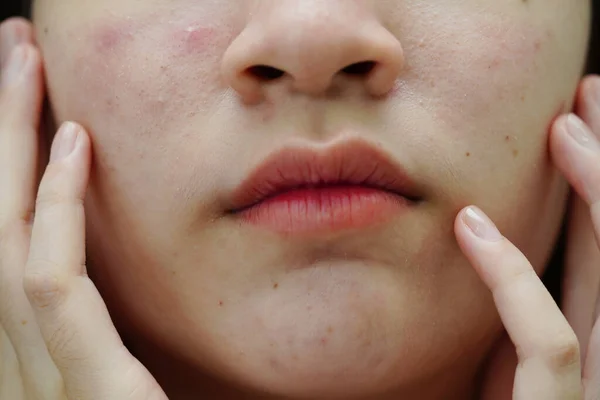 Acne pimple and scar on skin face, disorders of sebaceous glands, teenage girl skincare beauty problem.