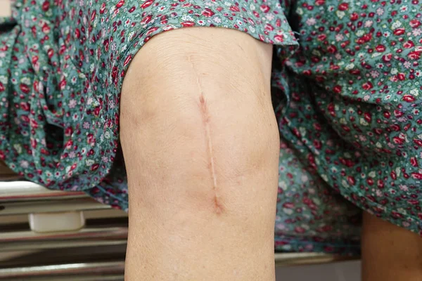 Asian elderly woman patient with scar knee replacement surgery in hospital.