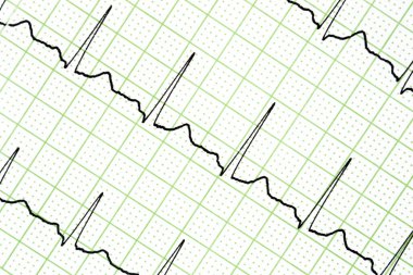 Elektrokardiyogram testi kalbin elektriksel aktivitesini gösteriyor..