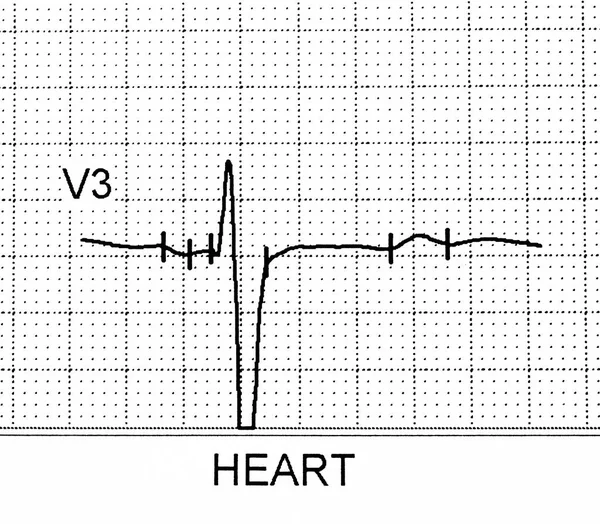 Electrocardiogram Test Shows Electrical Activity Heart — Stock Photo, Image