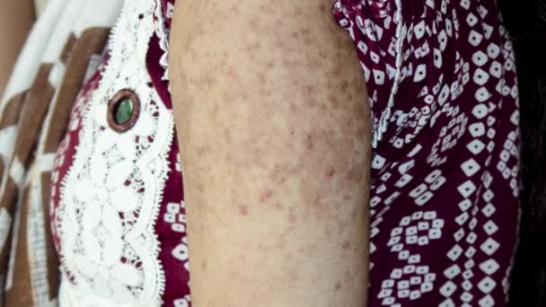 Close Dermatitis Skin Fungus Allergy Fungus Skin Concept Dermatology Treatment — Wideo stockowe