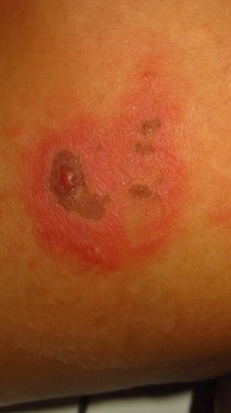 Cilt hastalığının bulanık ve bulanık bir resmi Herpes zoster kırmızı iltihaplı deri topakları kahverengi bir ciltte suyla dolu
