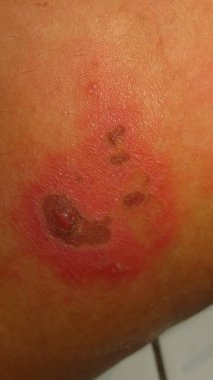 Cilt hastalığının bulanık ve bulanık bir resmi Herpes zoster kırmızı iltihaplı deri topakları kahverengi bir ciltte suyla dolu