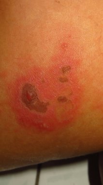 Cilt hastalığının bulanık ve bulanık bir resmi Herpes zoster kırmızı iltihaplı deri topakları kahverengi bir ciltte suyla dolu