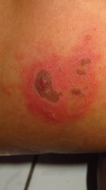 Cilt hastalığının bulanık ve bulanık bir resmi Herpes zoster kırmızı iltihaplı deri topakları kahverengi bir ciltte suyla dolu