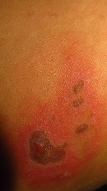 Cilt hastalığının bulanık ve bulanık bir resmi Herpes zoster kırmızı iltihaplı deri topakları kahverengi bir deride suyla dolu