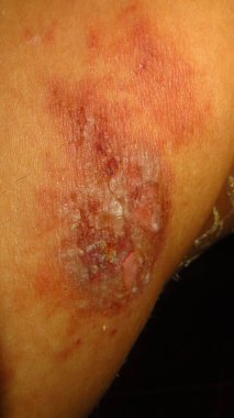 Uçuk derisi kaşıntısından dolayı hassas ve hafif çürümüş derinin bulanık ve bulanık bir resmi.