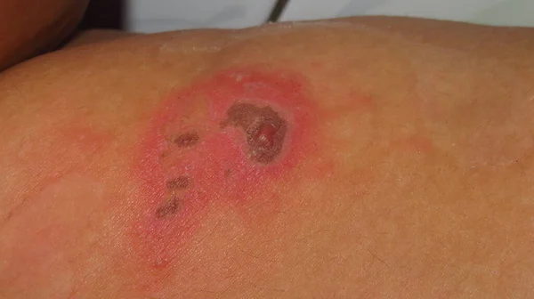 Imagine Încețoșată Granulată Bolii Piele Herpes Zoster Roșu Umflate Bucăți — Fotografie, imagine de stoc