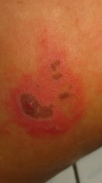 Imagem Turva Granulada Doença Pele Herpes Zoster Vermelho Inchaços Pele — Fotografia de Stock