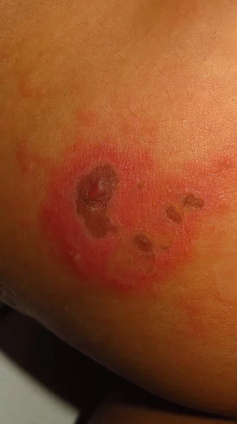 Blurry Grainy Picture Skin Disease Herpes Zoster Red Inflamed Skin — Stock Photo, Image