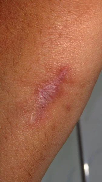Imagen Borrosa Granulada Queloide También Conocido Como Trastorno Queloide Cicatriz — Foto de Stock