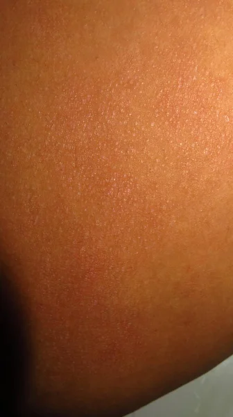 Quadro Sfocato Granuloso Pelle Screpolata Causa Prurito Una Pelle Marrone — Foto Stock