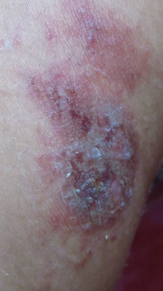 Imagem Desfocada Granulada Pele Dolorida Ligeiramente Podre Devido Herpes Doença — Fotografia de Stock