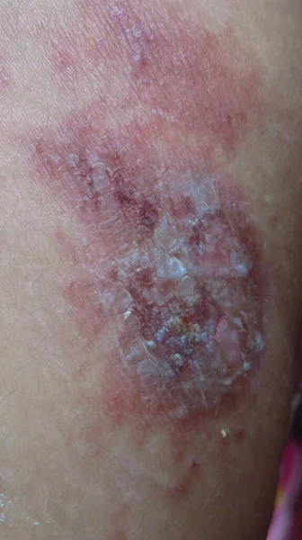 Rozmazaný Zrnitý Obraz Bolavé Mírně Hnijící Kůže Důsledku Herpes Kožní — Stock fotografie