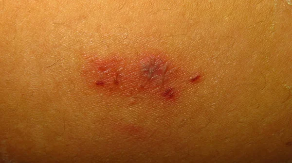 Imagem Desfocada Granulada Pele Dolorida Ligeiramente Podre Devido Herpes Doença — Fotografia de Stock