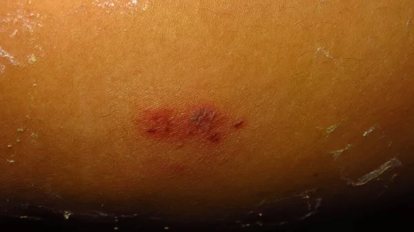 Blurry Grainy Picture Sore Slightly Rotting Skin Due Herpes Skin — Stock Photo, Image