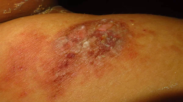 Imagine Încețoșată Granulată Pielii Inflamate Ușor Putrezite Din Cauza Bolii — Fotografie, imagine de stoc