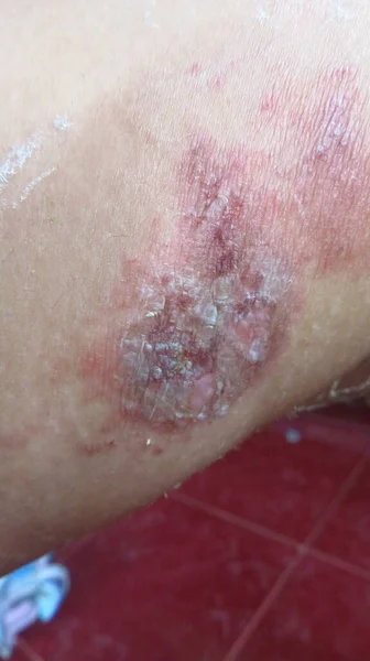 Blurry Grainy Picture Sore Slightly Rotting Skin Due Herpes Skin — Stock Photo, Image