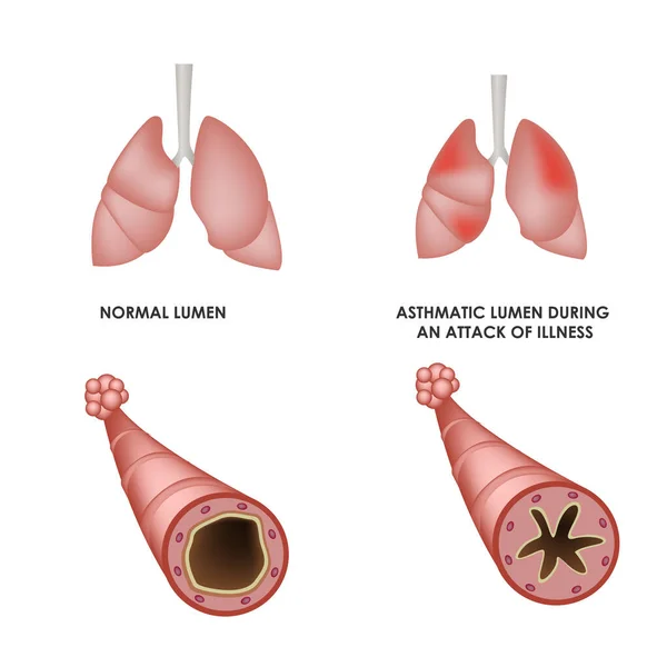 Polmoni e polmoni sani con malattia asmatica. Illustrazione medica realistica. — Vettoriale Stock