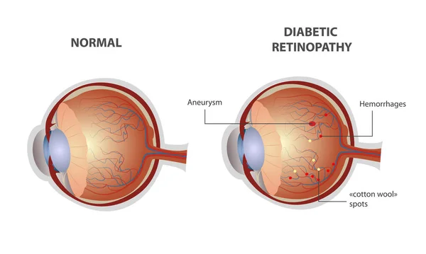Диабетическая ретинопатия, глаз, векторная медицинская иллюстрация с символами — стоковый вектор