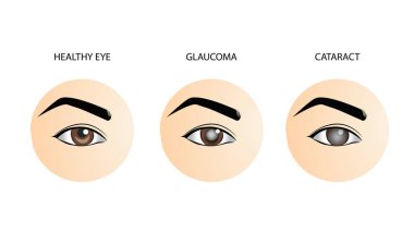 Normal göz, glokom ve katarakt, tıbbi vektör çizimi