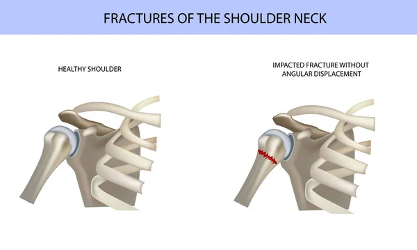 Fratture della spalla, illustrazione vettoriale medica — Vettoriale Stock