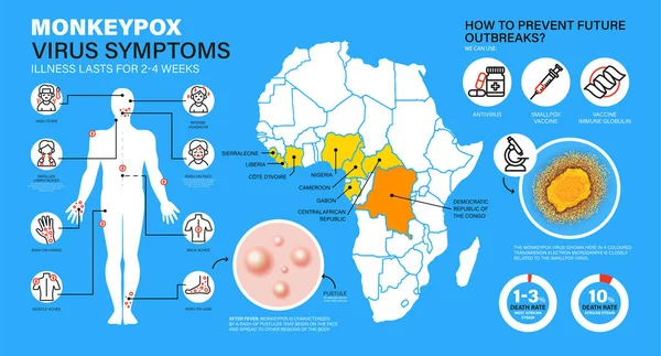 猴痘资讯图 猴痘病毒症状 在欧洲和美国报告了新的猴痘病毒病例 猴痘正在欧洲蔓延 会引起皮肤感染 — 图库矢量图片