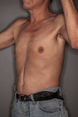 Karnında yara izi olan yaşlı bir adam.