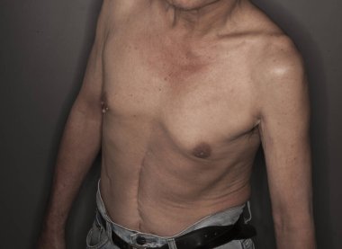 Karnında yara izi olan yaşlı bir adam.