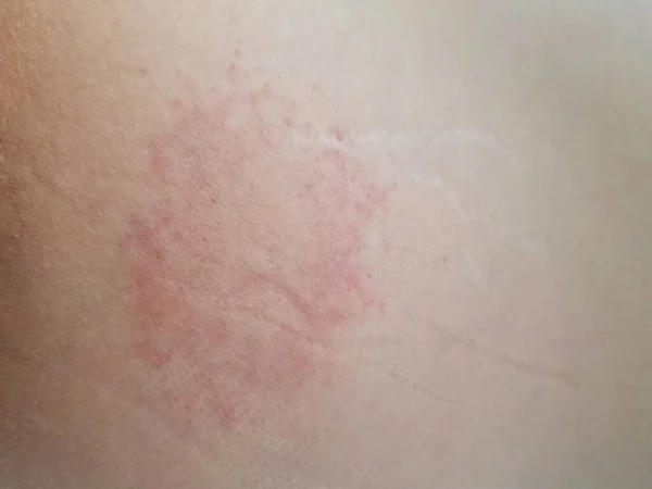 Piel Con Erupciones Cutáneas Urticaria Debido Vasitis Alergias — Foto de Stock