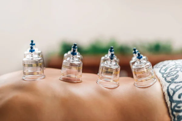 Hijama Gobelet Traitement Sur Dos Des Femmes — Photo