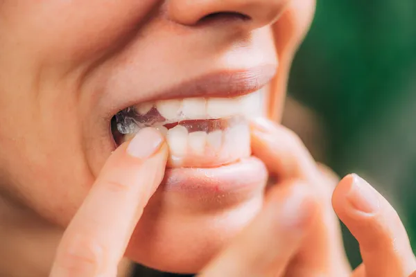 Whitestrips Branqueamento Dos Dentes Tiras — Fotografia de Stock