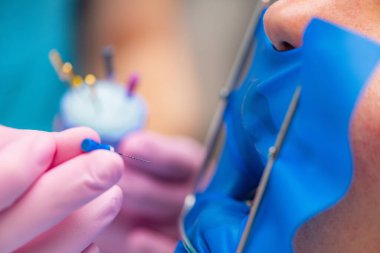 Endodontik kanal tedavisi süreci 