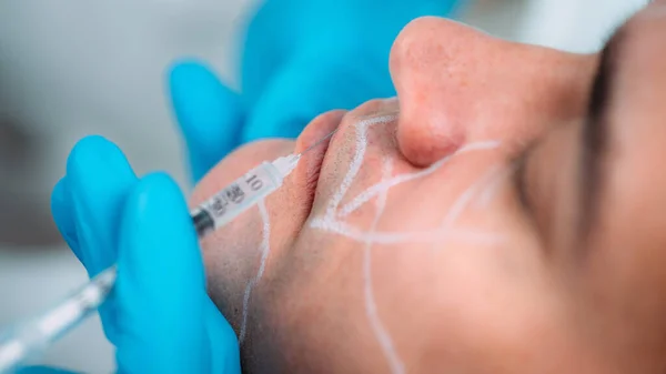 Doctor Injecting Dermal Filler Mans Lips — Stock Photo, Image