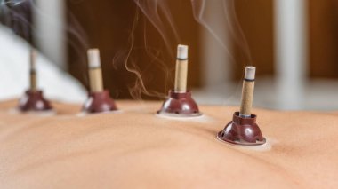 Moxibustion geleneksel Çin tıbbı tekniği. Yanan mugwort moxa çubuğuyla kadının sırtındaki meridyen noktalarına yerleştirilmiş..