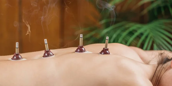 Mugwort moxibustion Back Therapy. Burning Moxa stick placed near acupuncture point on the patient\'s back.