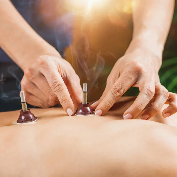 Moxibustion Therapy - Traditional Chinese Medicine. Placing burning Moxa stick on the back