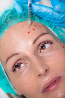 Pratik yüz enjeksiyonu. Orta yaşlı kadın, cilt kırışıklıklarını azaltmak için zengin plazma yüz enjeksiyonu aldı