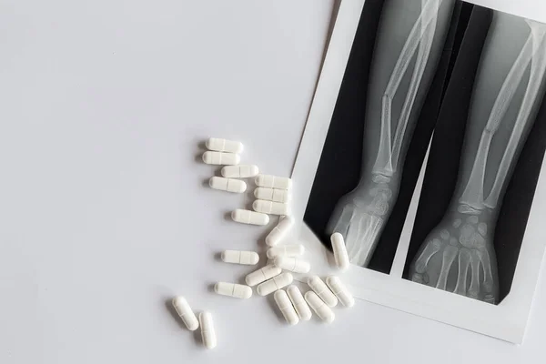 Röntgende kırık bir kol kemiği ve haplar görünüyor.