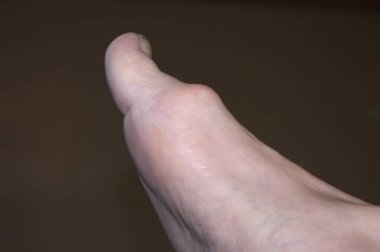 Ayağında nasır, hallux valgus var.