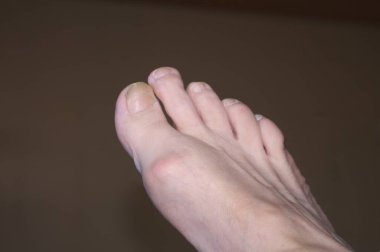 Ayağında nasır, hallux valgus var.