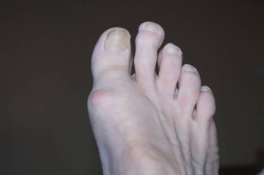 Ayağında nasır, hallux valgus var.