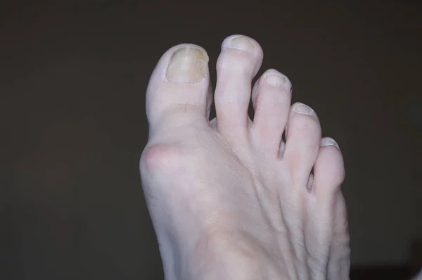 Oklädd Fot Med Knöl Hallux Valgus — Stockfoto