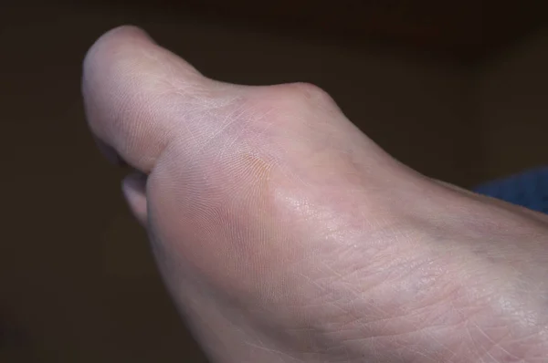 Γυμνό Πόδι Κότσι Hallux Valgus — Φωτογραφία Αρχείου